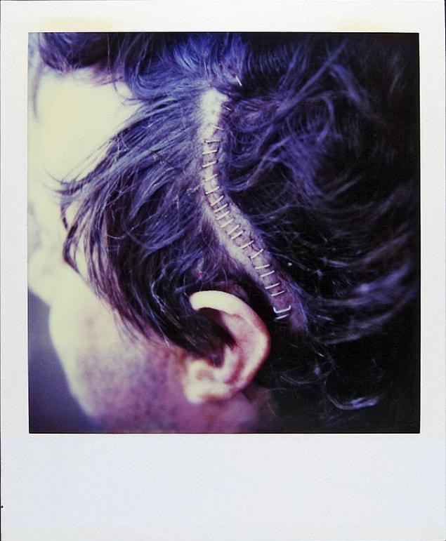 May 4, 1997: He has to have surgery, as seen by this scar on his head.