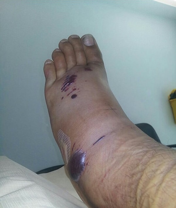 24. А вот, кстати, как выглядит ее укус