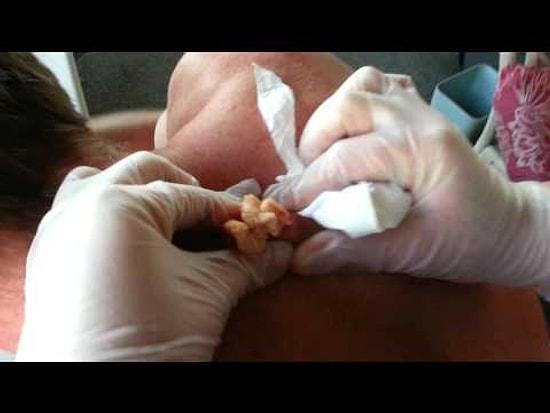 How A 30-Year-Old Cyst Is Removed From A Man's Body!
