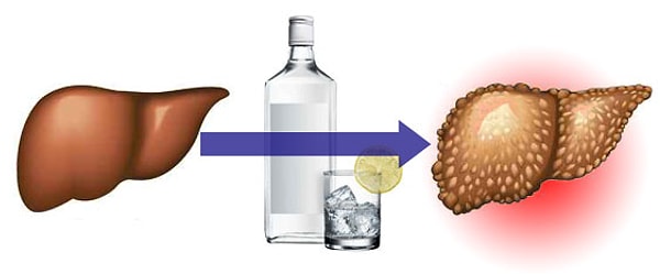 10. Любая порция алкоголя убивает клетки печени. Они гибнут и замещаются соединительной тканью и жиром, что очень часто приводит к циррозу и раку
