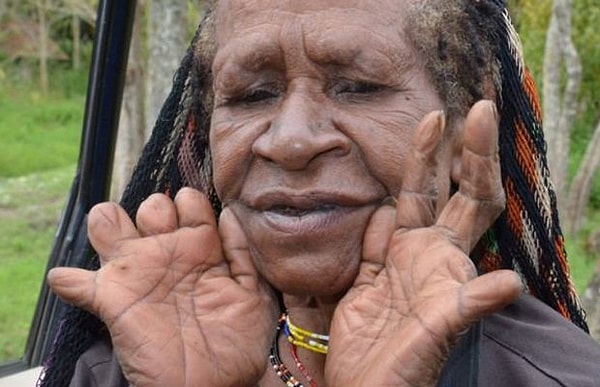 10. Племя больше не коптит тела умерших людей, но вместо этого они придумали другую традицию: теперь женщина должна отрубить себе палец, тем самым показывая свою скорбь и успокаивая дух ушедшего родственника