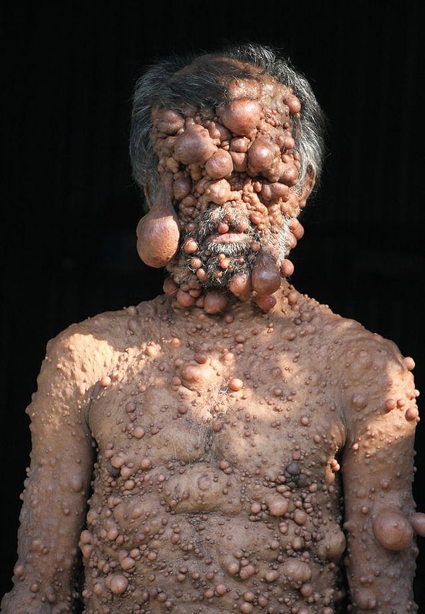 1. Знакомьтесь, это Шадот Хоссейн. Мужчина страдает наследственным заболеванием нейрофиброматозом