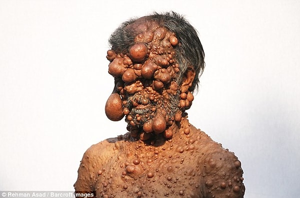 3. Но хуже всего то, что если в скором времени ему не сделают операцию, он может навсегда потерять зрение