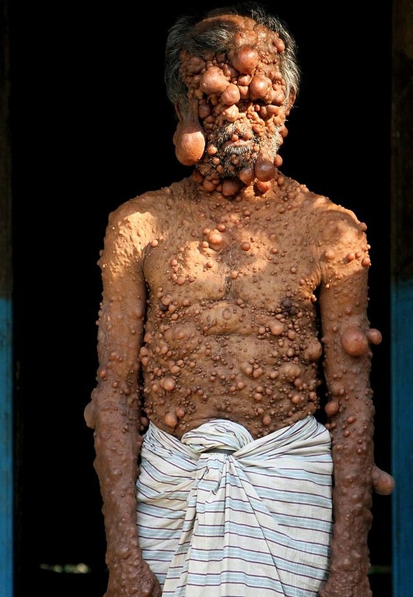 2. Все его тело покрыто болезненными опухолями из-за чего он даже не может носить одежду