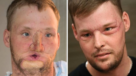 Tüfekle İntihara Teşebbüs Edip, Yüzünü Parçalayan Adama Yüz Nakli Yapıldı!