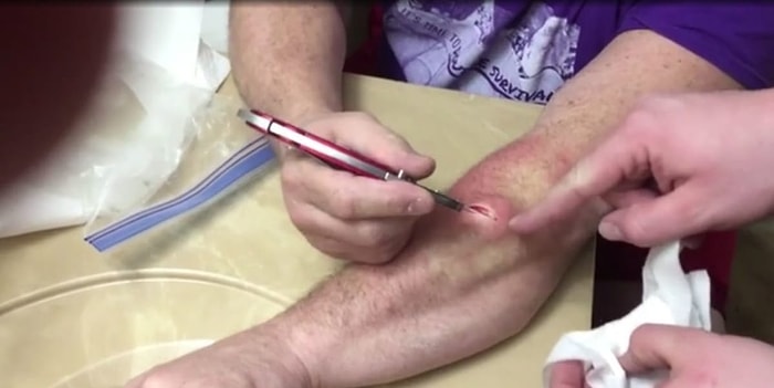 Kolundaki Devasa Kisti Çıkarmak İçin Bıçak Kullanan Adam