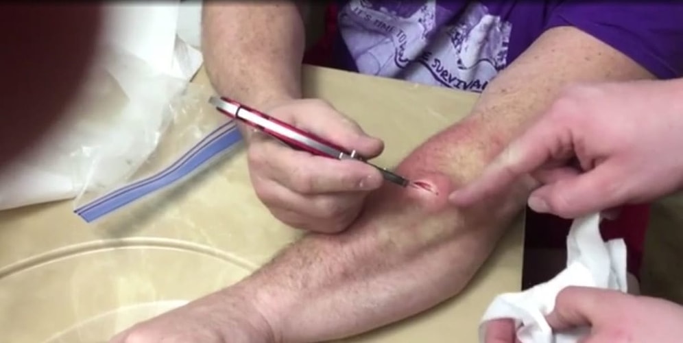 Kolundaki Devasa Kisti Çıkarmak İçin Bıçak Kullanan Adam