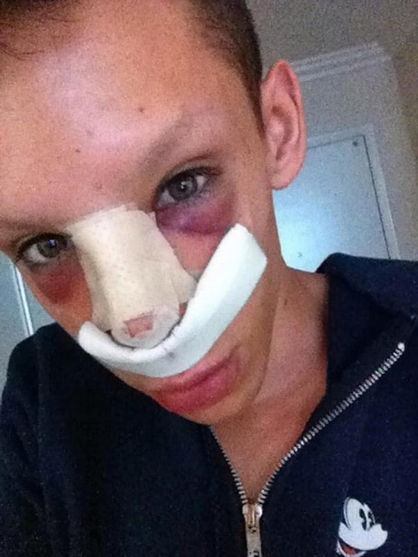 2. С тех пор он провел более 110 косметических процедур и операций общей стоимостью $50.000 в надежде превратиться в бесполого инопланетянина