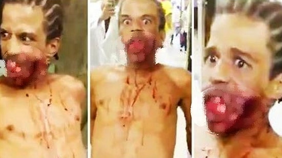 Suratından Vurulduktan Sonra Hastanede Zombi Gibi Dolaşan Adam