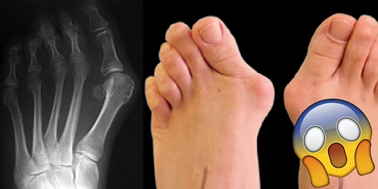 Günümüzde Pek Çok Kadının Kabusu Olan Sağlık Sorunu: Ayak Başparmağı Çıkıntısı