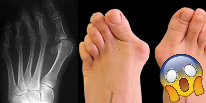 Günümüzde Pek Çok Kadının Kabusu Olan Sağlık Sorunu: Ayak Başparmağı Çıkıntısı