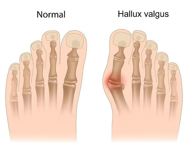 Halluks valgus, zamanla başparmak kemiklerini birleştiren eklemin ve onu saran yağ yastıkçığının dışa doğru deforme olması ve ayakta bir şişlik oluşturması demek.