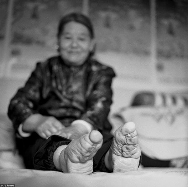 Rahatsızlık, eski çağlardaki Çinli Kadınların ayak bağlama geleneğinin modern versiyonu gibi duruyor.