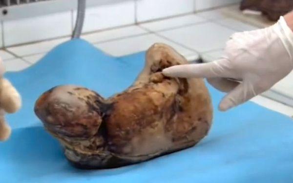 Zahra had an ectopic pregnancy, where the fetus had burst the fallopian tube and was developing in the abdominal cavity. Later, the dead fetus had become a foreign object. Therefore, the mother’s body formed a calciferous shell around it mummifying the fetus. Surgeons successfully removed the fetus from Zahra’s body.