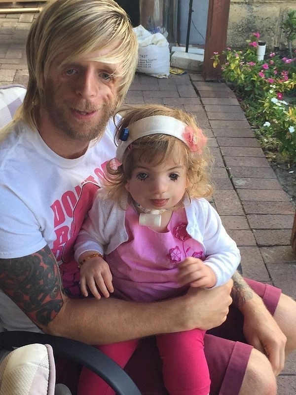 17. К примеру, этой девочке потребовалось сделать трахеостомию — операцию, которая помогла ей дышать