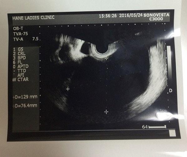 Ultrasonun ardından Endometriozis ve yumurtalık kistleri teşhisi kondu. Yumurtalıkları 13 santimetre kadar şişmişti.