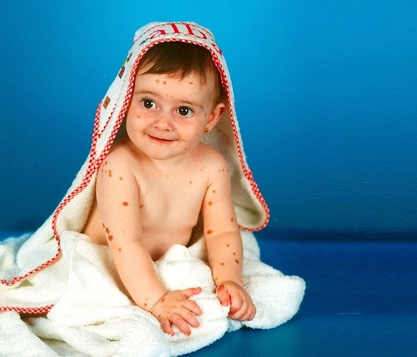 4. В детстве ей пришлось перенести около 30 операций, чтобы удалить некоторые пораженные участки кожи