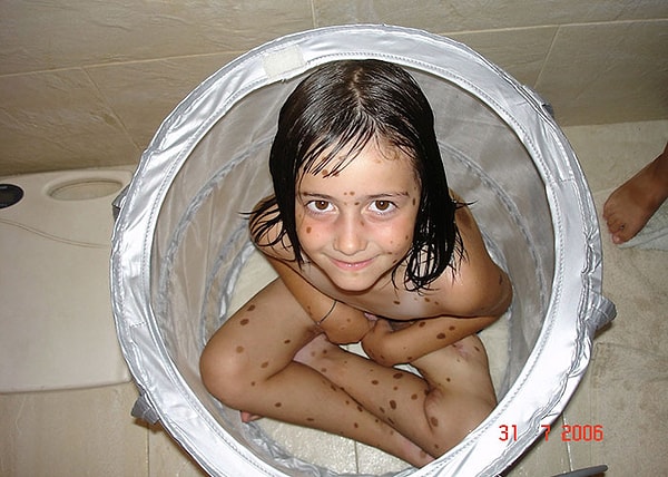 5. Сверстники жестоко издевались над ней, дразнили ее "монстром" и "далматином"