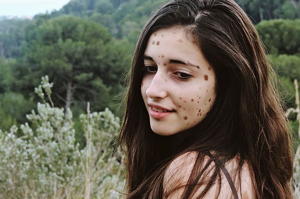 7. Она опубликовала фотографии своей кожи в Интернете, снимки Альбы получили тысячи ретвитов и лайков, что помогло ей поверить в себя и принять участие в местной кампании в качестве модели