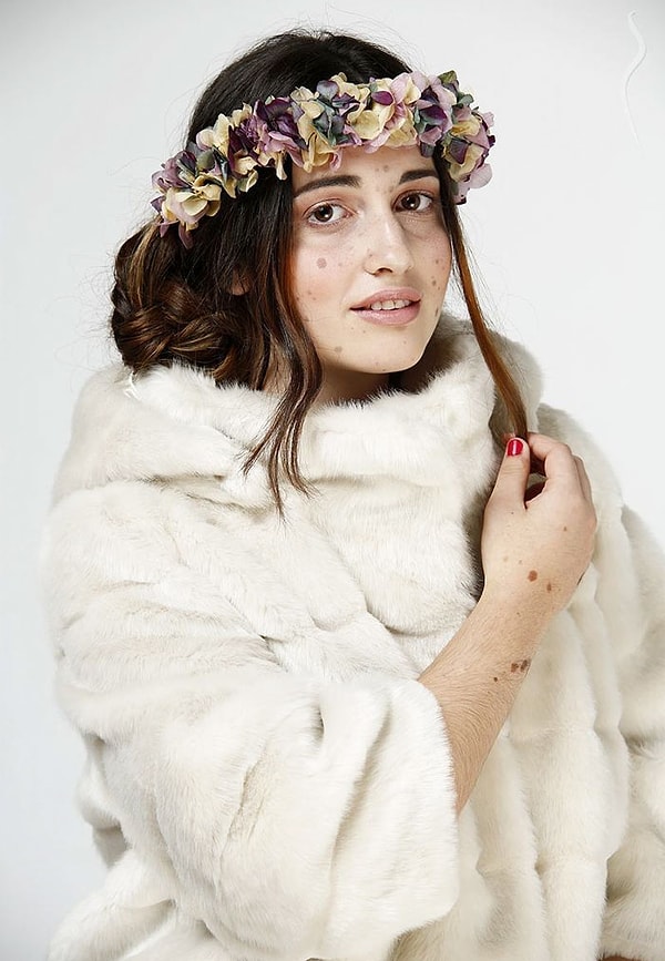 9. "Я чувствую себя гораздо уверенней и пытаюсь рассказать миру о моем заболевании, чтобы помочь людям с такими же проблемами", — пишет Альба на своей личной страничке