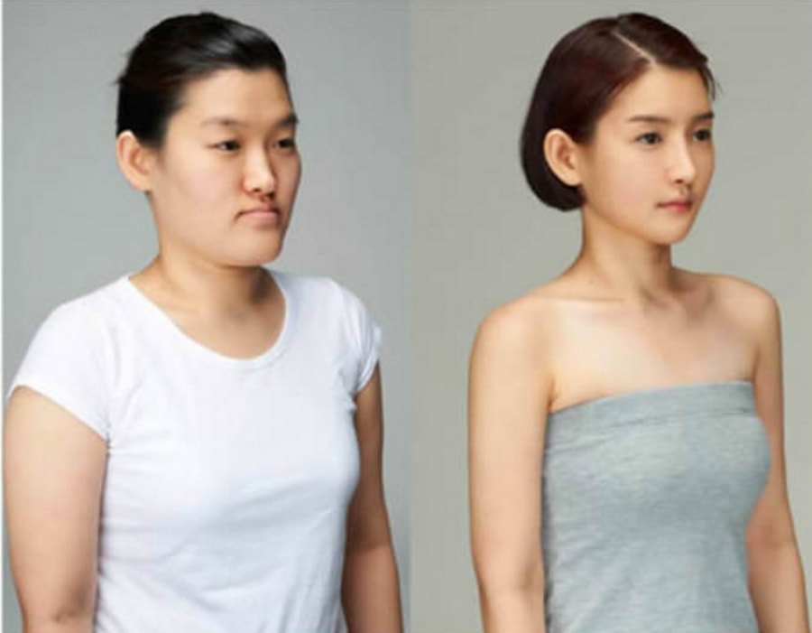 19 Mind Blowing Before And After Faces From South Korea's Plastic