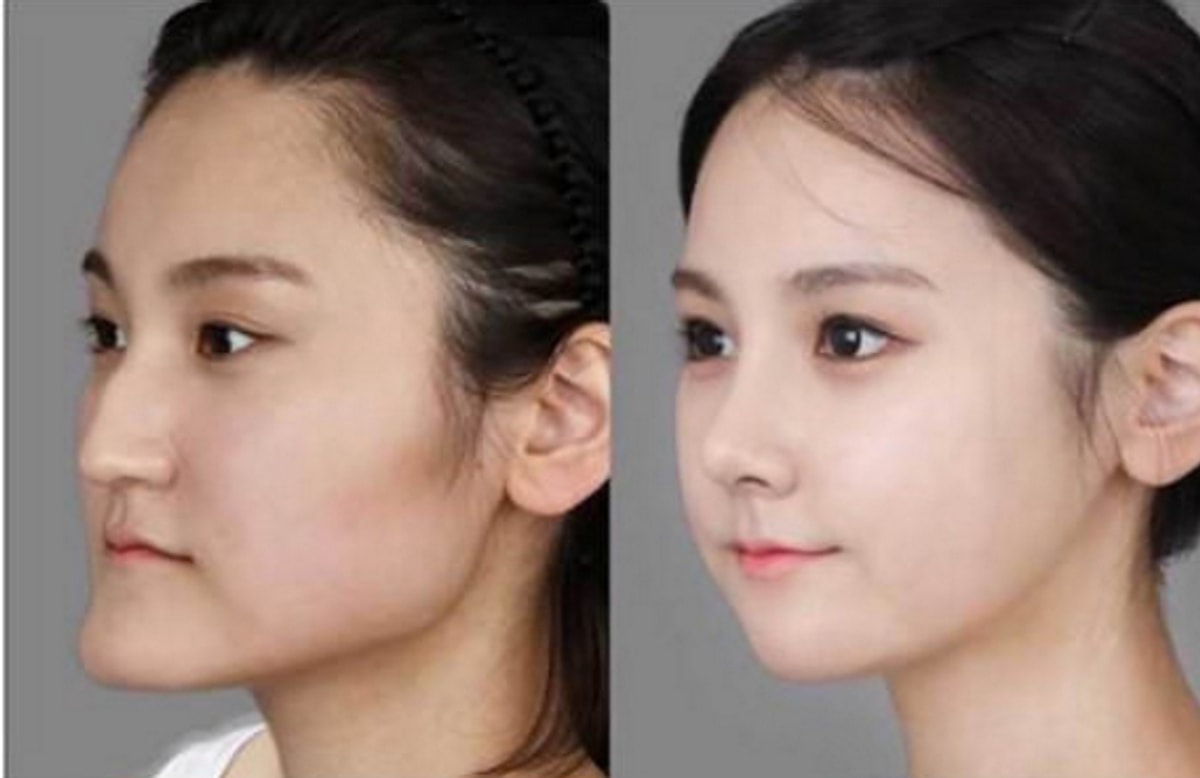 19 Mind Blowing Before And After Faces From South Korea's Plastic