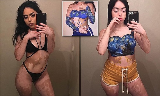 Vücudundaki Vitiligo Rahatsızlığı Lekelerini Onları Boyayarak Sevmeyi Öğrenen Cesur Kadın