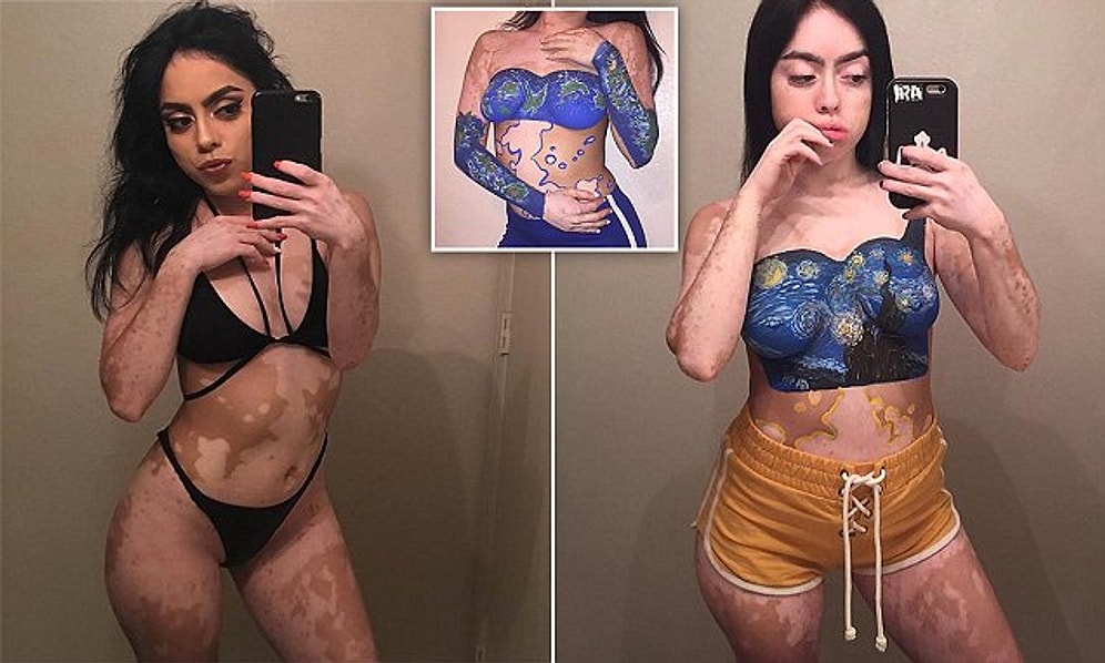 Vücudundaki Vitiligo Rahatsızlığı Lekelerini Onları Boyayarak Sevmeyi Öğrenen Cesur Kadın