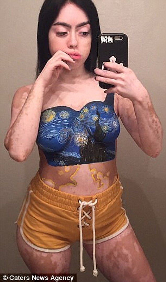 Ashley Soto, 21, from Orlando, Florida, was diagnosed with vitiligo at the age of 12 and had white spots on her body because of it.