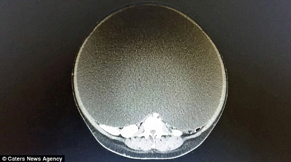 5. Это рентгеновский снимок кисты яичника этой женщины