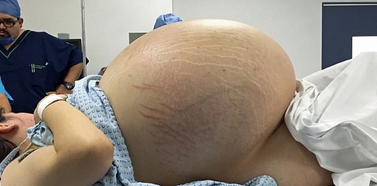 Самая большая киста в мире? Женщине провели операцию по удалению опухоли весом в 33 кг
