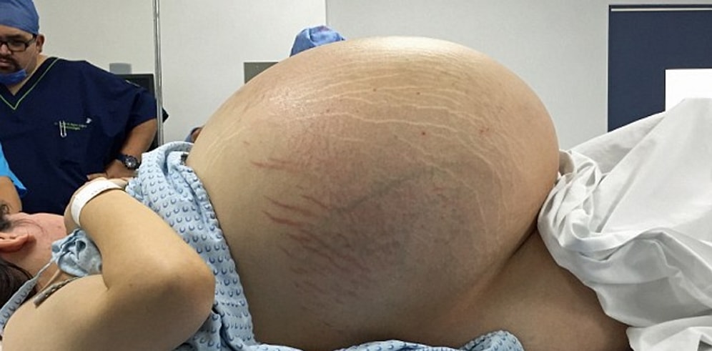 Самая большая киста в мире? Женщине провели операцию по удалению опухоли весом в 33 кг