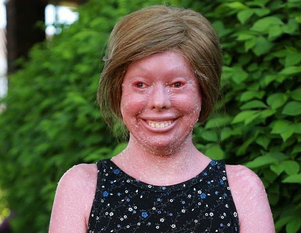 6. Ихтиоз Арлекина