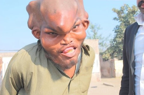 10. Синдром Протея