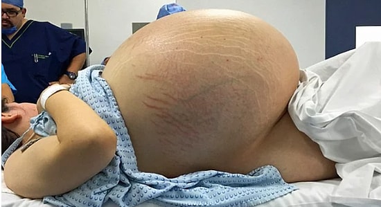Bir Kadının Yumurtalığında On Bebek Ağırlığına Ulaşıp Organlarını Parçalayan Kist