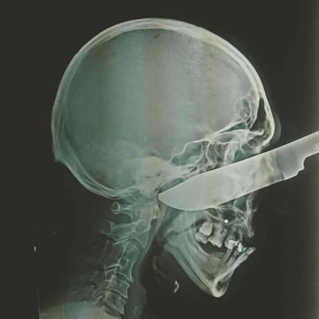 6. Can you believe that this X-ray belongs to a person who became the victim of a furious sibling! 😨