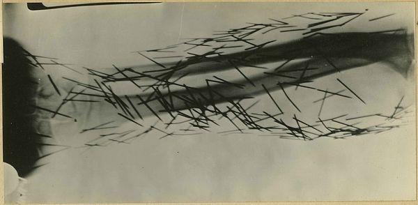22. An X-ray image of needles driven into the flesh by a psychiatric patient.