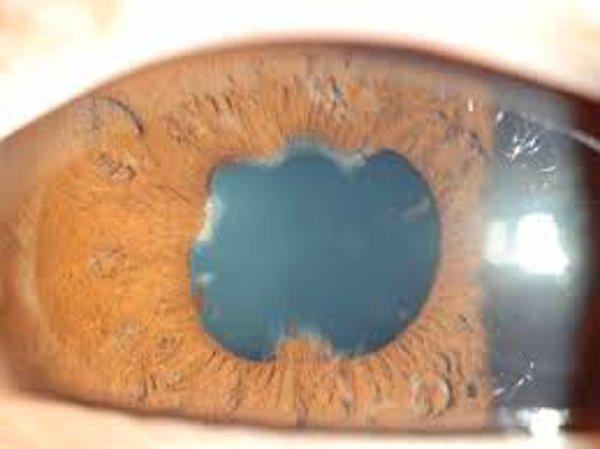 Gözün renkli kısmı olan irisi çevreleyen bu zarın yırtılması ve parçalanması ise oldukça nadir görülür.