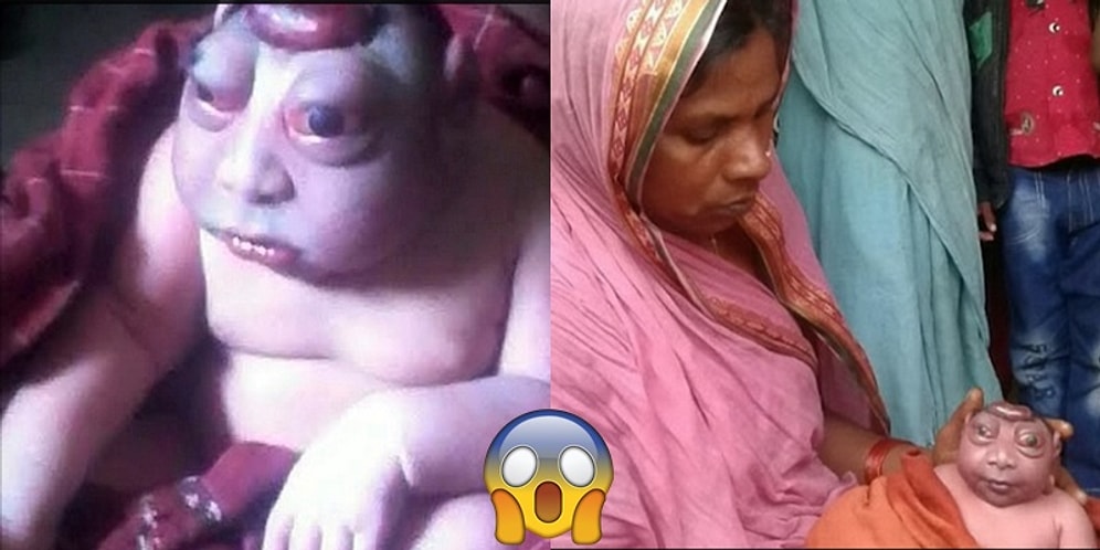 Çocuğu Diğer Çocuklardan Farklı Göründüğü İçin Onu Emzirmeyi Reddeden Anne