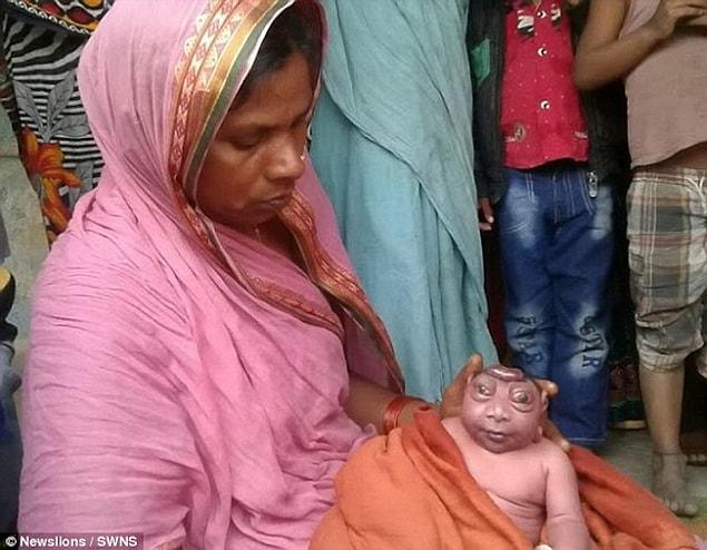 Doctors in India diagnosed the baby with an extremely rare genetic condition called Harlequin Ichthyosis, which gives sufferers thick skin and deformed features.
