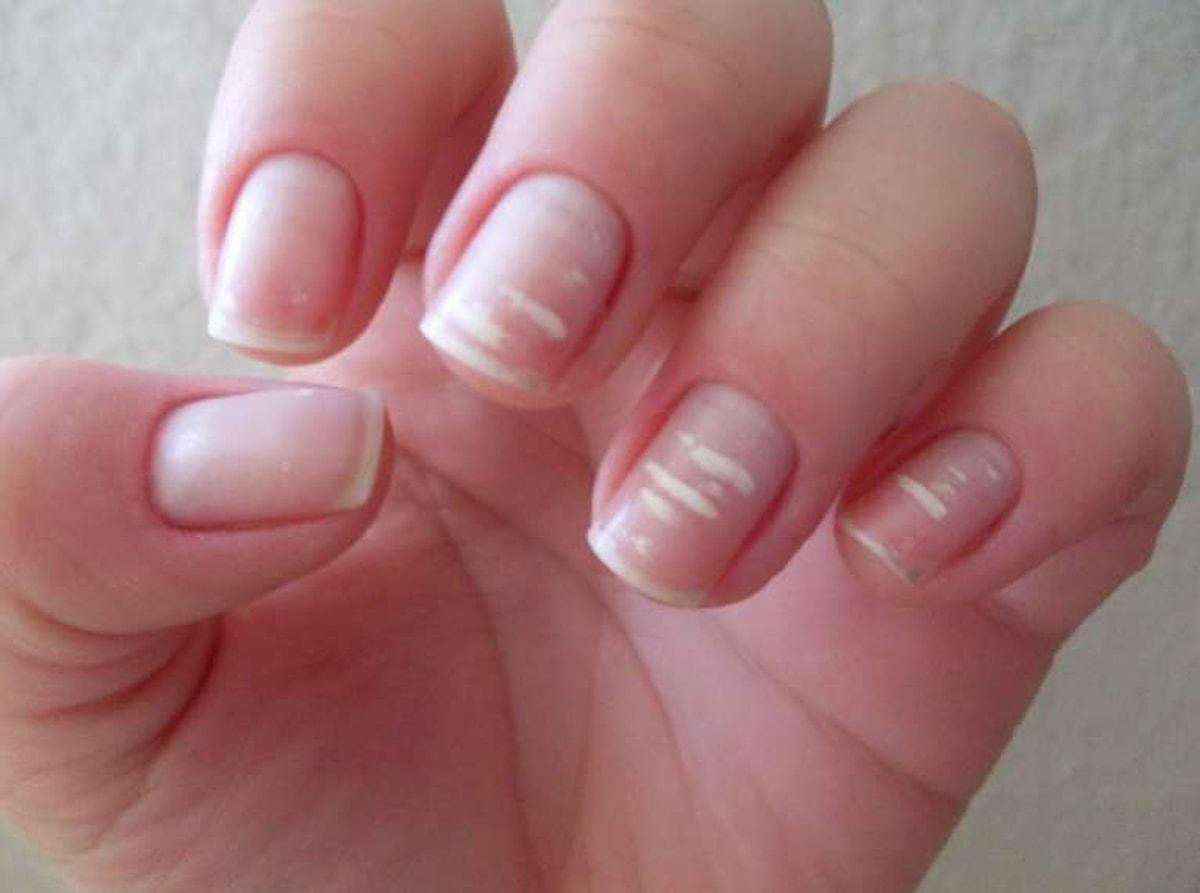 Что означают полосы на ногтях. Лейконихия белые пятна на ногтях. Лейконихия (белые пятнышки). Белые полоски - лейконихия ногтей.