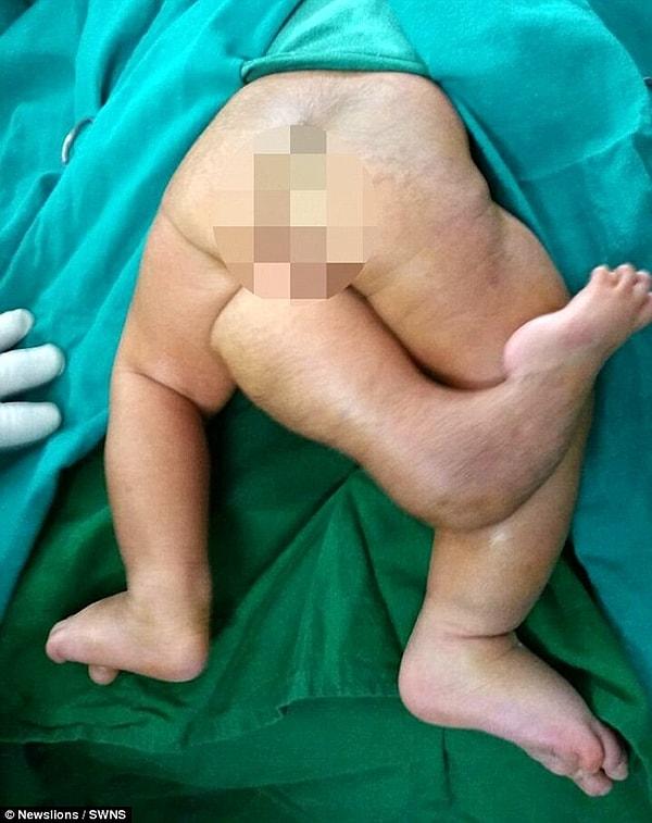 Fakat doğan bebekte çok nadir rastlanan bir doğum anomalisi vardı. Bebek 3 adet bacakla dünyaya geldi.