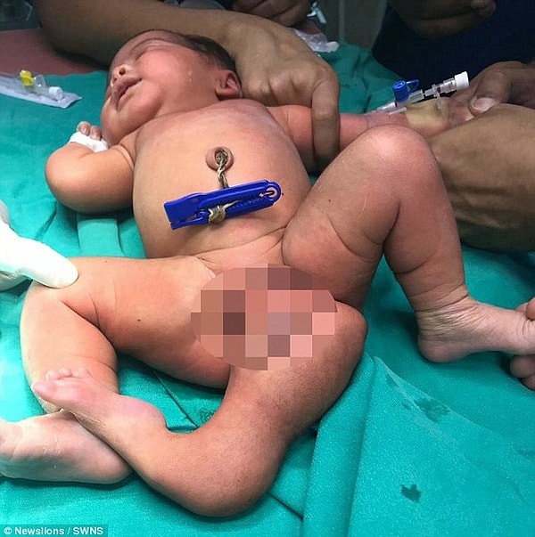 "Doktorların bu istenmeyen uzuv üzerinde ameliyat yapabileceklerinden emindim. Bizi hayal kırıklığına uğratmadılar. Onları bize Allah gönderdi," dedi 25 yaşındaki anne Srilatha.