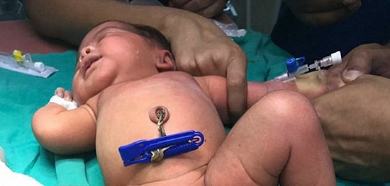 Hindistan'da Fazla Uzvu Başarılı Bir Ameliyatla Alınan 3 Bacaklı Bebek