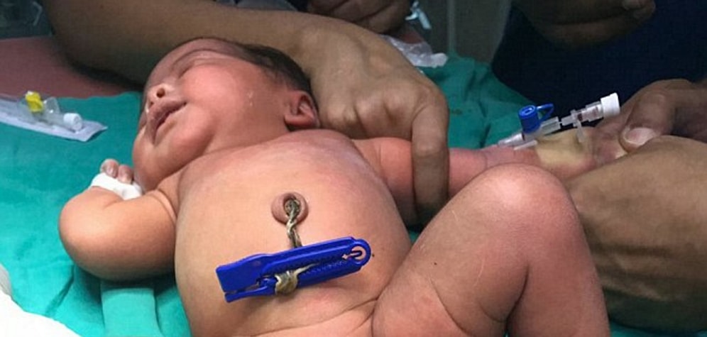 Hindistan'da Fazla Uzvu Başarılı Bir Ameliyatla Alınan 3 Bacaklı Bebek