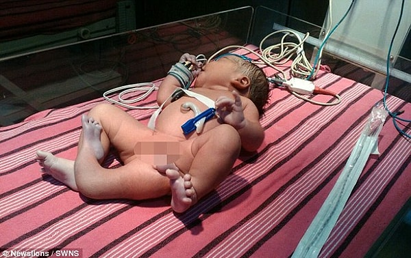 4. Несмотря на то, что девочка родилась с лишней конечностью, ее здоровье в норме