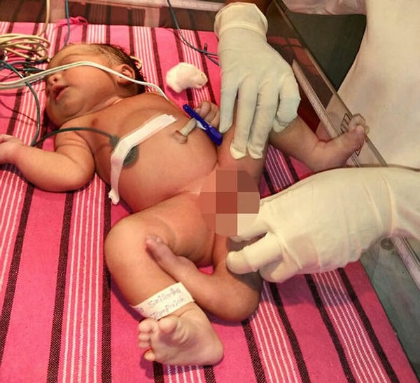 5. Доктор Рамеш Редди, глава департамента педиатрической хирургии, утверждает, что подобный случай очень редкий, шанс появления такого ребенка примерно 100 тыс. к одному