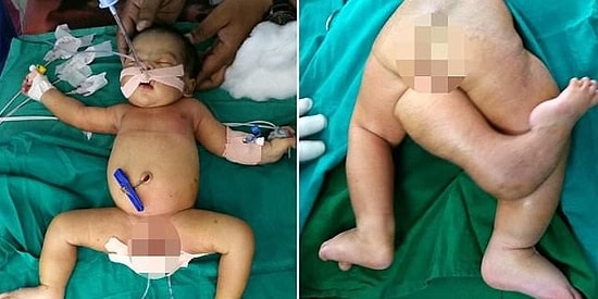 В Индии родилась девочка с 3 ногами: доктора смогли провести успешную операцию