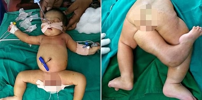 В Индии родилась девочка с 3 ногами: доктора смогли провести успешную операцию