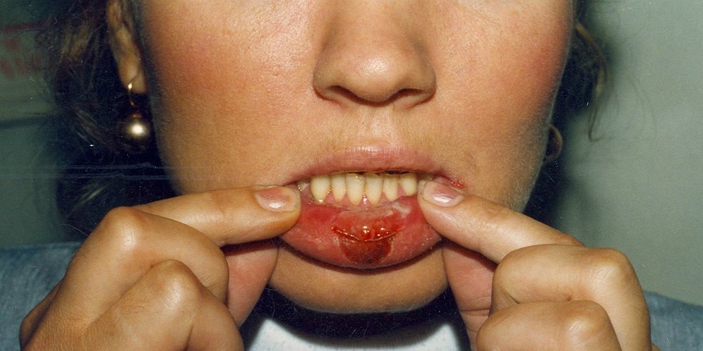 15 самых ужасных болезней, подхватить которые и врагу не пожелаешь